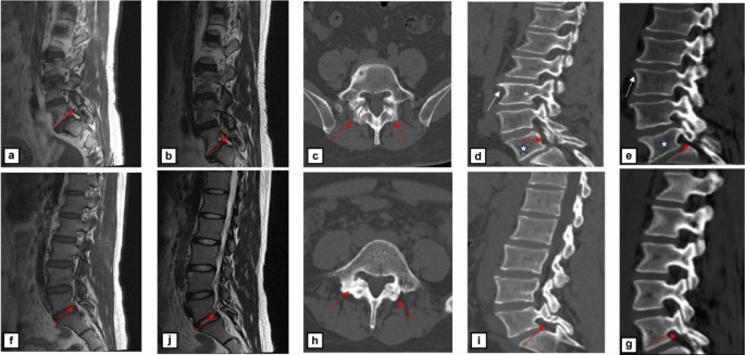 合成 CT 技术如何革新腰椎峡部裂诊断？临床案例解析