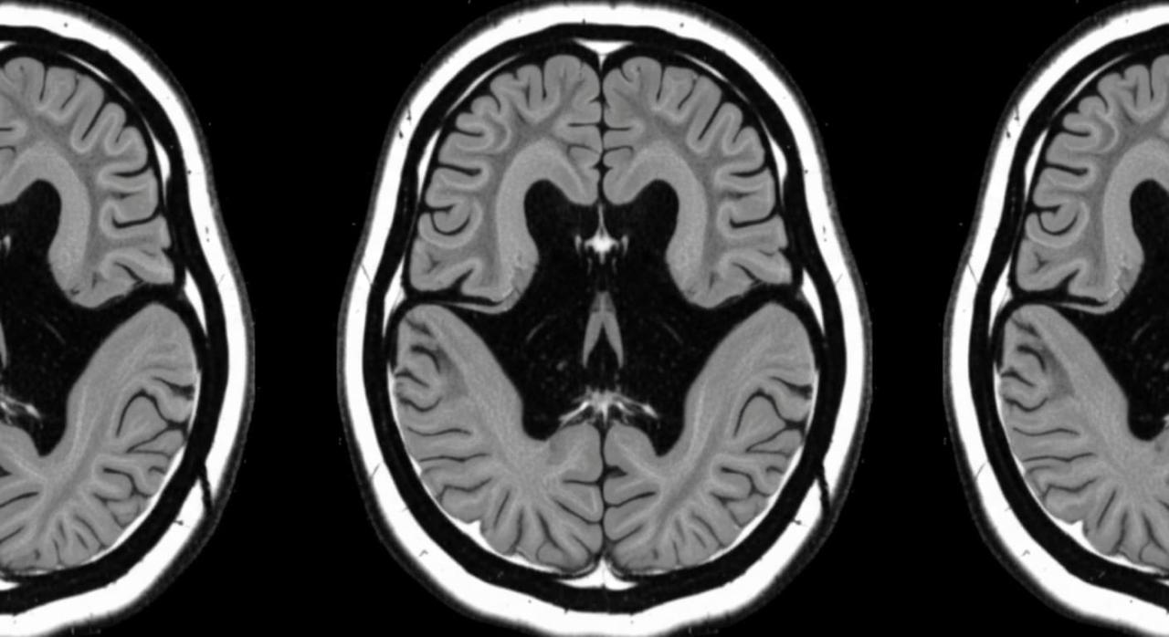 宾夕法尼亚州立大学 AI 语音分析:1 分钟筛查,捕捉阿尔茨海默病早期迹象 宾夕法尼亚州立大学 AI 语音分析:1 分钟筛查,捕捉阿尔茨海默病早期迹象